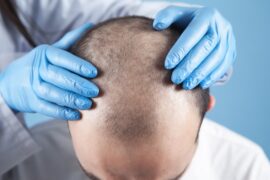 How To Find the Best Clinic for Hair Transplant Surgery in Delhi NCR?